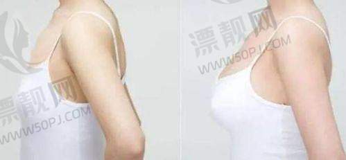 优选医院与傲诺拉假体隆胸
