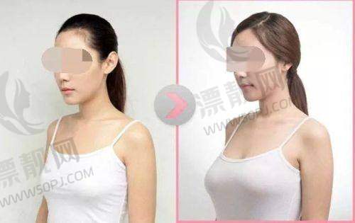 傲诺拉假体的价格及不同类型对比