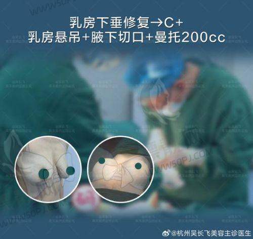 傲诺拉假体隆胸的术后成效