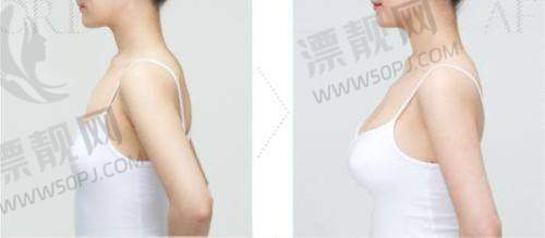 傲拉诺假体隆胸的优势有哪些？