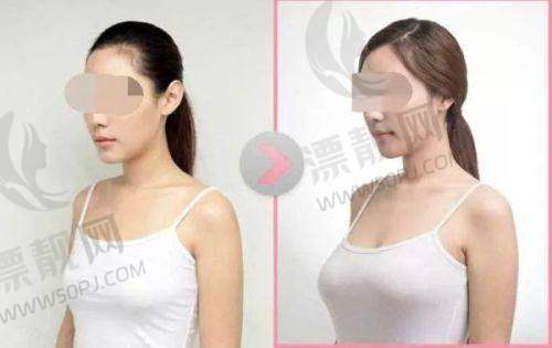 隆胸40天手感如何？