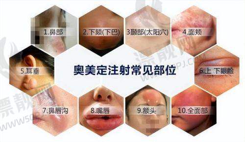傲诺拉假体有几个系列？