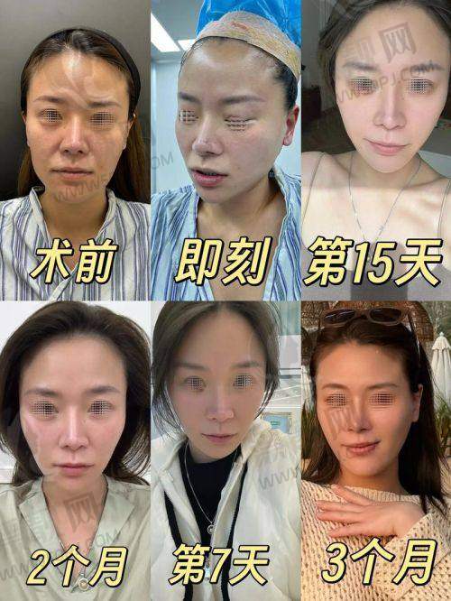 北京加减美医疗美容面部提升成效怎么样？