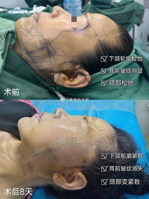 北京加减美医疗美容面部提升成效咋样？