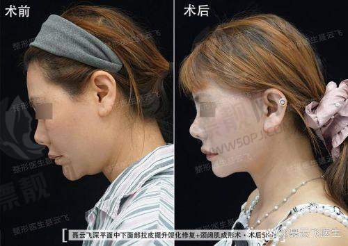 北京加减美医疗美容面部提升成效：真有那么神？