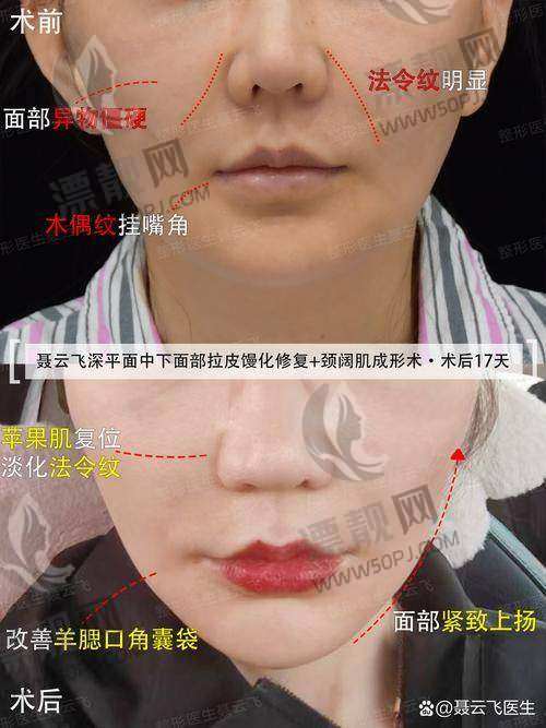 北京加减美医疗美容是不是莆田系？探秘其正规性、面部提升效果及美容 v6 价格！