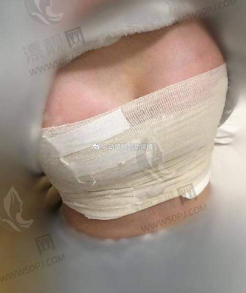 傲诺拉假体隆胸的价格情况