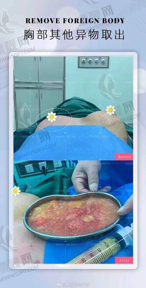 傲诺拉假体的优势