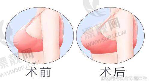 傲诺拉假体隆胸的价格体系