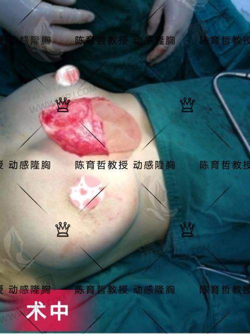 傲诺拉假体值不值得买？优点真的不少