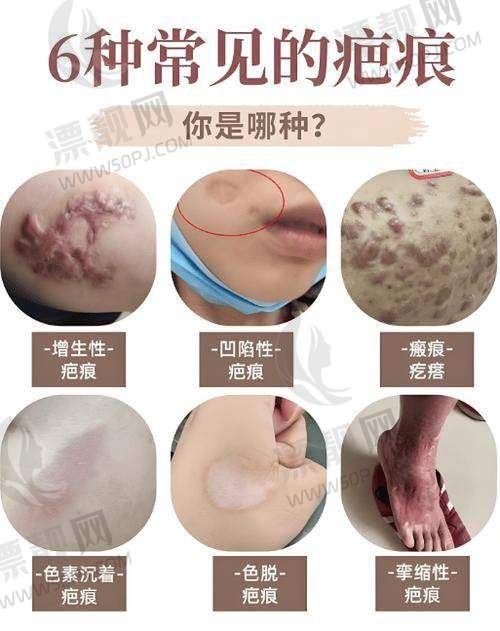 四川友谊医院疤痕科