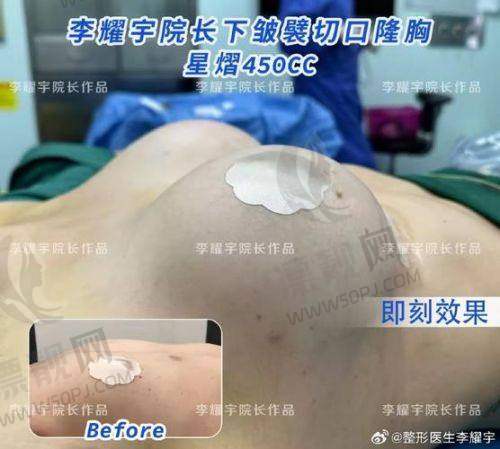 想了解假体隆胸傲诺拉？350CC大吗、和278CC差多少及价格、效果保持时间全解析