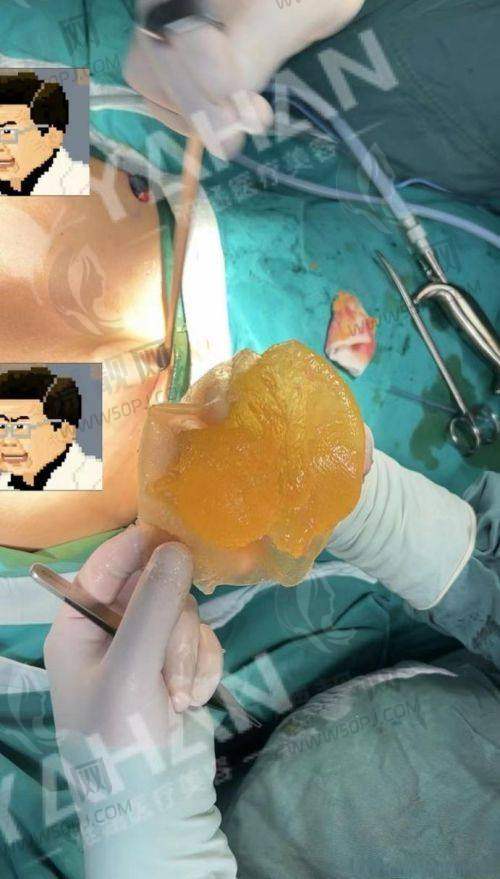 傲诺拉是假体都是毛面的吗？“面子问题”大有讲究
