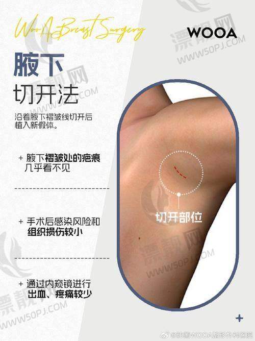 如何购买傲诺拉隆胸假体