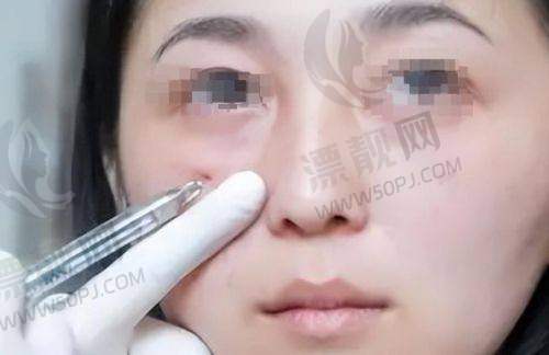 保定贵夫人医疗美容院光子治酒糟鼻收费合理上榜前十，美容师招聘与加盟支持都有！
