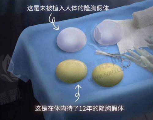 想了解假体隆胸傲诺拉多少钱、350CC大吗？星熠光面效果、尺寸及变软时间全解析！