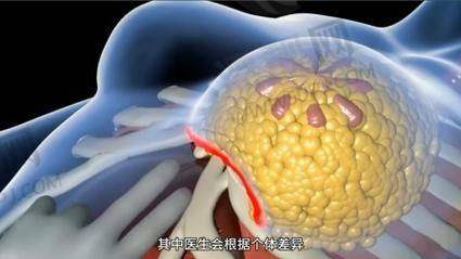 傲诺拉假体隆胸的术前准备和术后护理