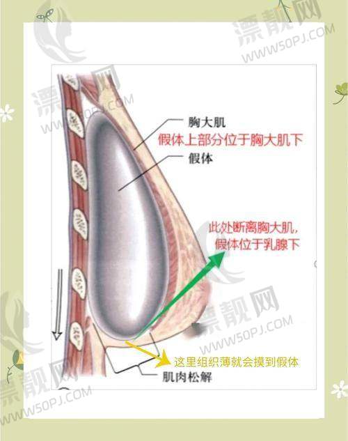傲诺拉假体隆胸的价格分析