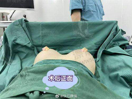 傲诺拉假体隆胸的优势
