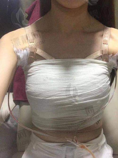 傲诺拉假体隆胸究竟多少钱？探秘傲诺拉假体系列，看看它是否真的值得选！