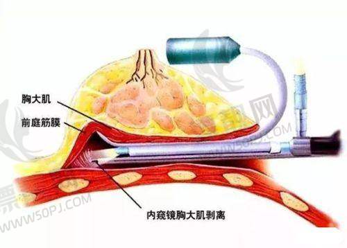 傲诺拉隆胸假体价格几何