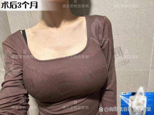 广州傲诺拉假体隆胸价格几何？傲诺拉系列、优势及手感体验在论坛引发热议！