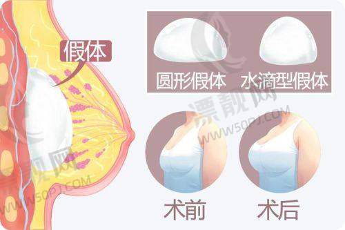 医美攻略与傲诺拉假体隆胸