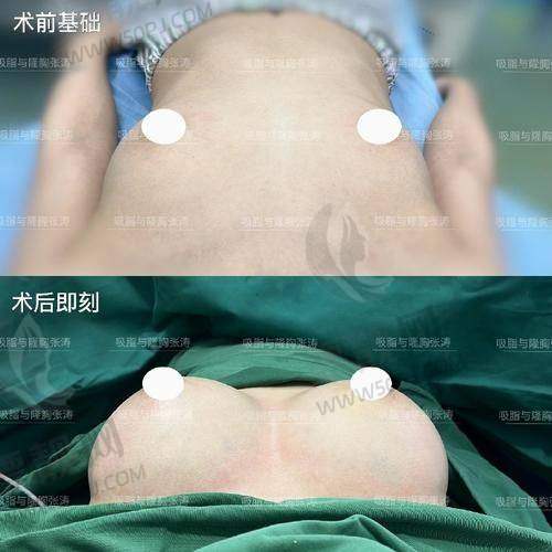 傲诺拉璀璨隆胸假体价格及适用人群