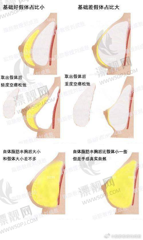 医美机构活动与傲诺拉假体隆胸