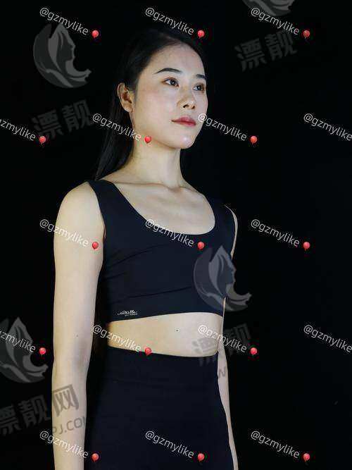 傲诺拉闪耀假体隆胸价格几何?后遗症、变软时间及假体系列型号全知晓!
