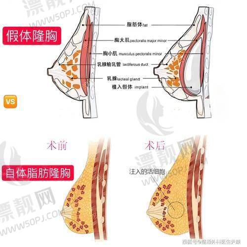 傲诺拉闪耀假体系列型号介绍
