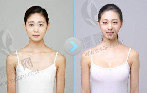 傲诺拉隆胸假体的优势几何?