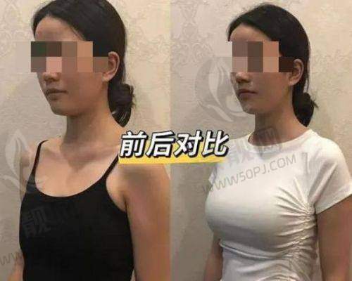优选医院与傲诺拉璀璨假体隆胸术