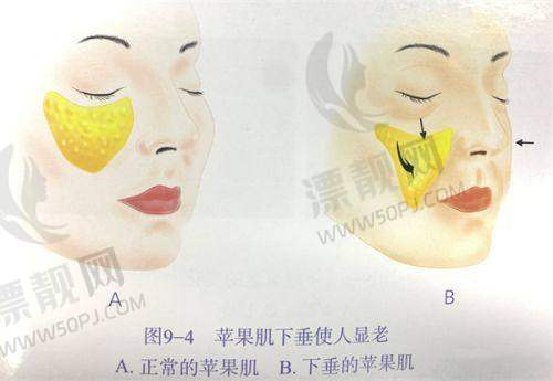 悬吊手术提升项目