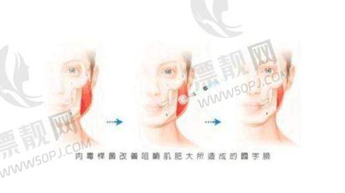 双模嫩肤项目介绍