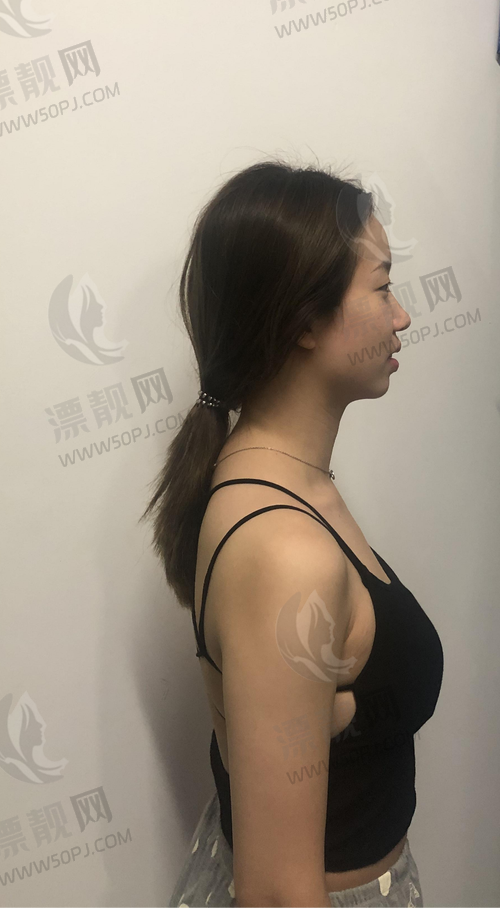 傲诺拉假体系列大揭秘:傲诺拉璀璨怎么样,价格几何,从包装盒到隆胸效果全知晓!