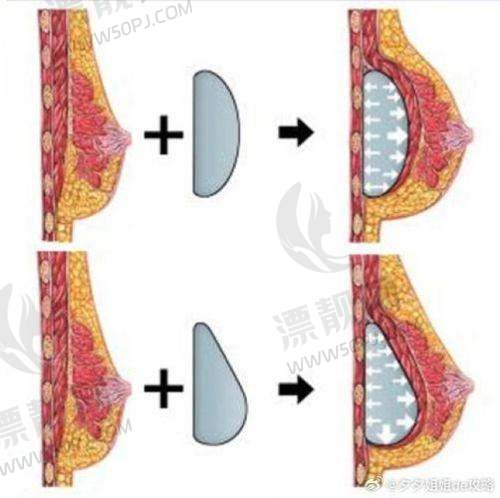 傲诺拉璀璨假体隆胸术价格几何