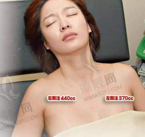 与傲诺拉假体隆胸相关的其他医美信息