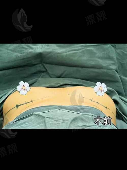 如何避免术后胸外扩?医生这样建议
