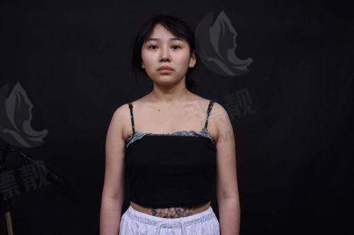 傲诺拉假体隆胸术后胸外扩正常吗?傲诺拉隆胸40天手感如何及价格大揭秘!