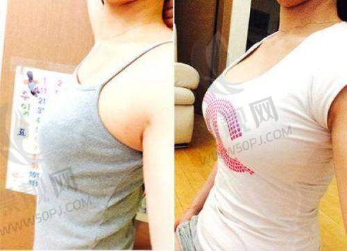 傲诺拉假体隆胸术的优势