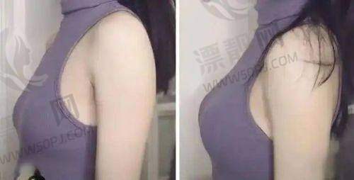 傲诺拉假体隆胸术的价格