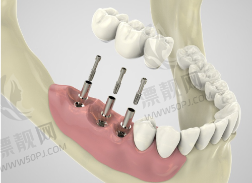 热门项目“大起底”——种植牙、矫正、儿牙样样在线！