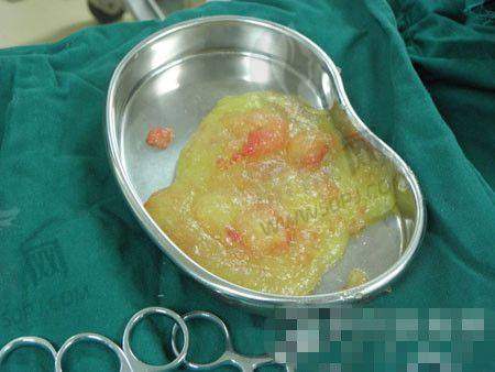 尾声小Tips:做傲诺拉假体前该准备啥?