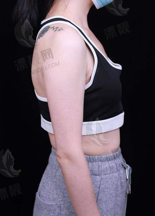 选择傲诺拉是假体隆胸的“黄金搭子”吗?