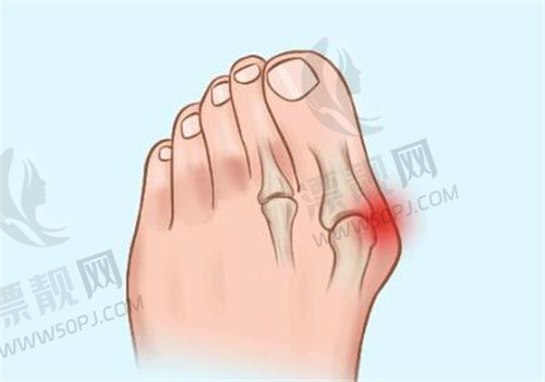 做拇外翻手术选温建民医生不会踩坑！技术、口碑、价格全解析，助你重拾健康美足