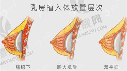 傲诺拉假体光面与绒面的区别