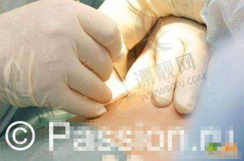 傲诺拉假体的优势