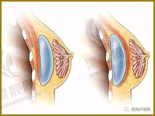 傲诺拉假体的系列特点