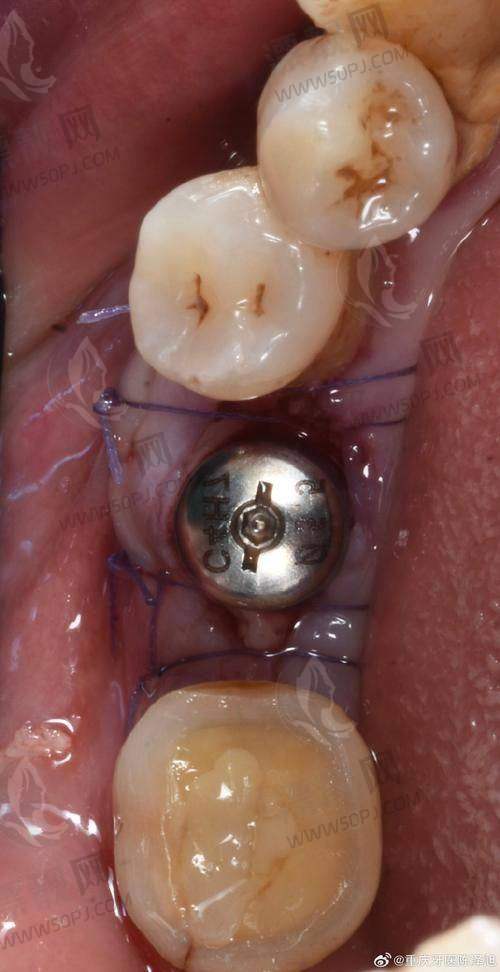 四、北京中诺口腔价格表大全——种植牙矫正全都有